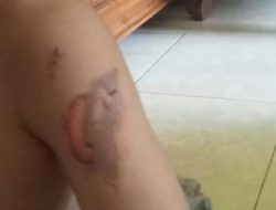 Diduga terjadi Pembiaran”Anak kelas 3 SD Mengalami Luka Bakar”